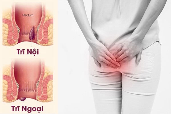 Bệnh viện Chợ Rẫy có Giám đốc mới ảnh 5 Cảnh báo: Người phụ nữ nhận hậu quả khi dùng thuốc nam chữa trĩ lâu năm