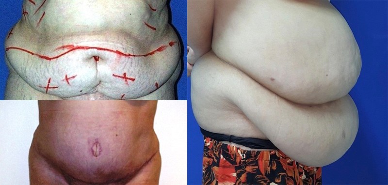 Phần bụng của chị H. trước và sau khi phẫu thuật