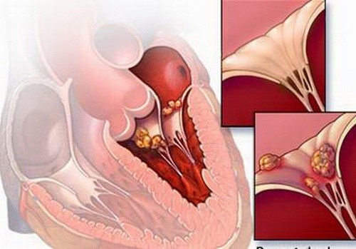 Những cách đơn giản phòng ngừa bệnh viêm cơ tim ảnh 3 Thực hư thông tin 'virus lạ gây bệnh dịch viêm cơ tim'