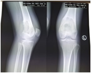 Phim chụp X-quang phần xương đùi của bệnh nhân