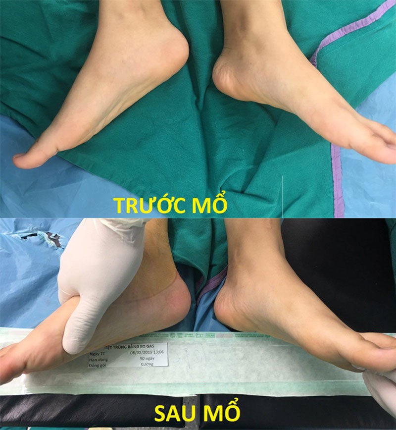 Mãi tới lần thứ 3 phẫu thuật, bệnh của C. mới được chữa khỏi, đồng thời, khắc phục dáng đi khác thường của em. Mãi tới lần thứ 3 phẫu thuật, bệnh của C. mới được chữa khỏi, đồng thời, khắc phục dáng đi khác thường của em.