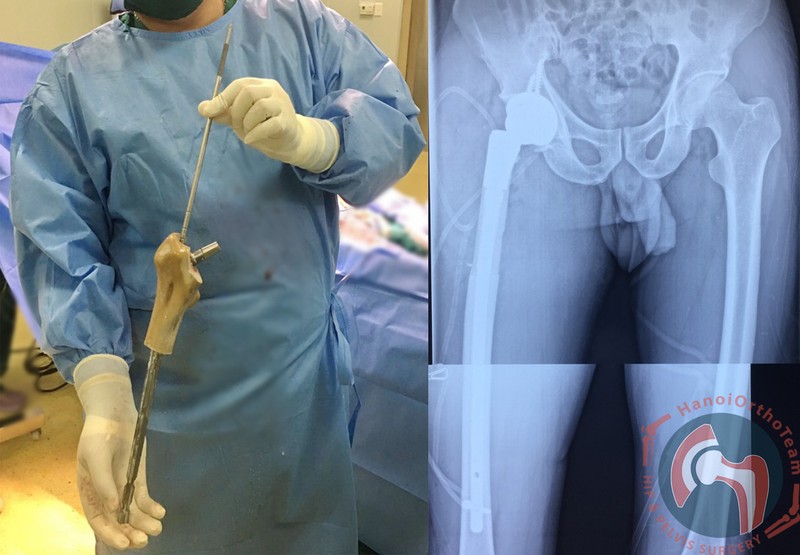 Hình ảnh thực tế của đoạn xương nhân tạo được cấy ghép