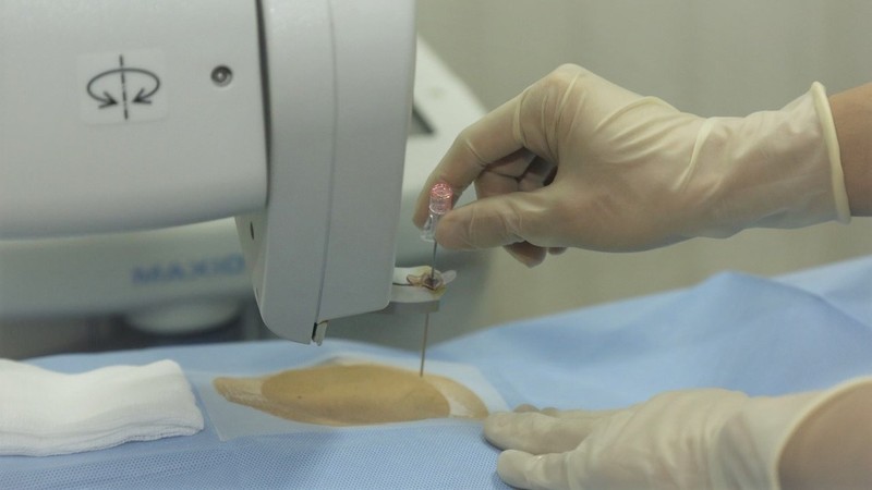 Chỉ với một lần chọc kim duy nhất, các bác sĩ can thiệp chính xác vào vị trí của hạch thân tạng. Chỉ với một lần chọc kim duy nhất, các bác sĩ can thiệp chính xác vào vị trí của hạch thân tạng.