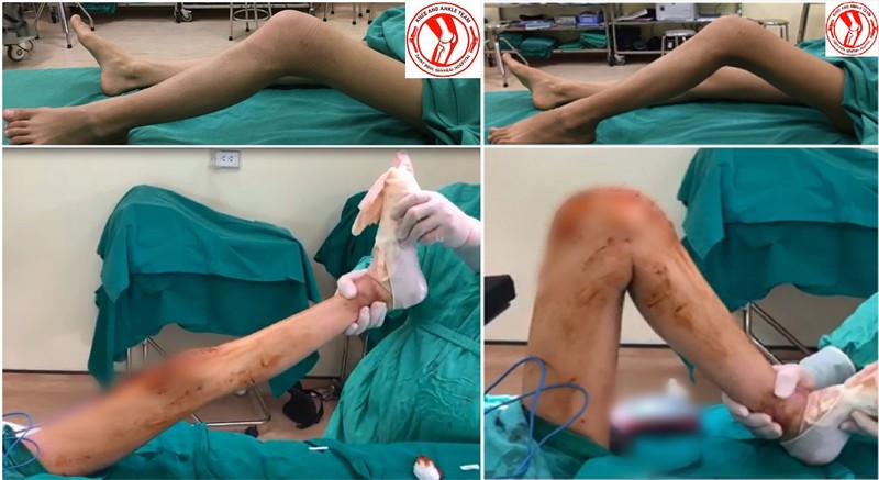 Tình trạng chân của bệnh nhân U. trước và sau khi phẫu thuật. Tình trạng chân của bệnh nhân U. trước và sau khi phẫu thuật.