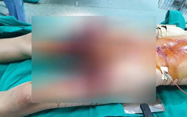 Bệnh nhi bị thương (Ảnh: BVCC)