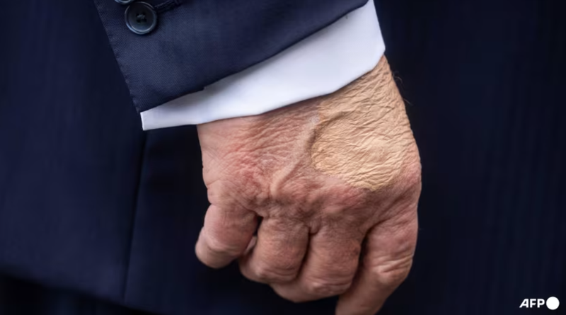 Bàn tay phải của ông Trump được nhìn thấy khi ông phát biểu với báo chí trước khi lên trực thăng Marine One tại Bãi cỏ phía Nam của Nhà Trắng vào ngày 15/7. Ảnh: AFP. Ông Trump được chẩn đoán suy tĩnh mạch chân, Nhà Trắng nói gì.png