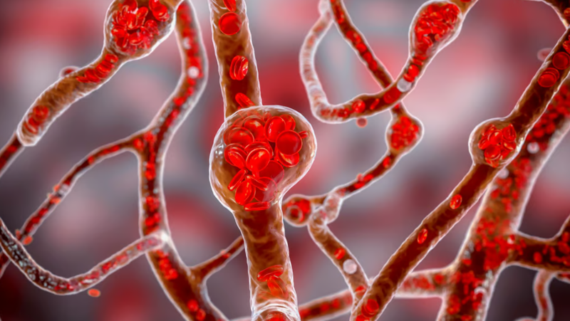 Theo Ahilan Kailaya-Vasan, bác sĩ phẫu thuật thần kinh tại Bệnh viện King's College ở London, phình động mạch não giống như một quả bóng bay nhỏ ở bên cạnh mạch máu. Ảnh: Shutterstock. Kim Kardashian tiết lộ bị phình mạch não Mức độ nguy hiểm ra sao, điều trị như thế nào 2.png