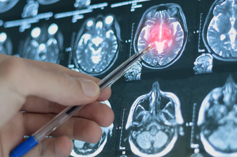 Phình động mạch não vỡ có thể gây xuất huyết dưới nhện nguy hiểm đến tính mạng. Ảnh: Shutterstock. Kim Kardashian tiết lộ bị phình mạch não Mức độ nguy hiểm ra sao, điều trị như thế nào 4.png