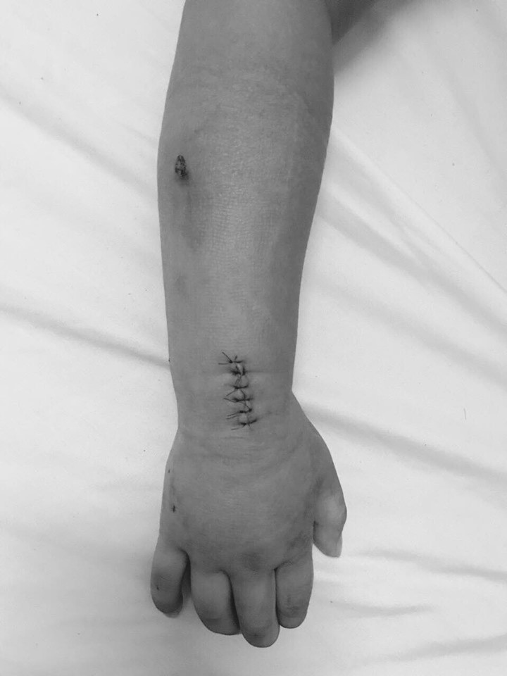 Tay bé trai sau ca phẫu thuật Tay bé trai sau ca phẫu thuật