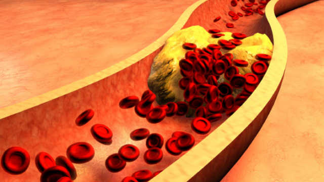 Cholesterol trong máu. Ảnh: Internet