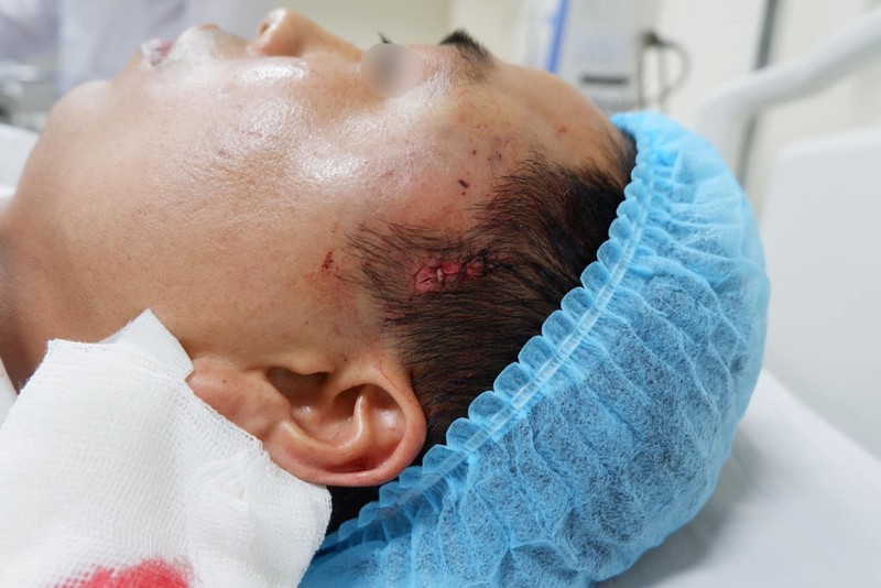 Thái dương của bệnh nhân sưng phồng sau khi phẫu thuật tại cơ sở thẩm mỹ không phép. Ảnh: Bệnh viện E Thái dương của bệnh nhân sưng phồng sau khi phẫu thuật tại cơ sở thẩm mỹ không phép. Ảnh: Bệnh viện E