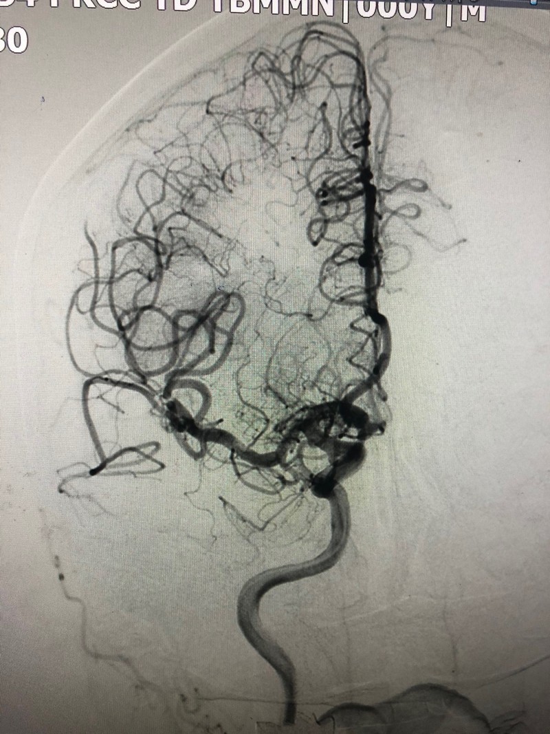 Tái thông động mạch não giữa sau can thiệp lấy huyết khối. Ảnh: BVCC