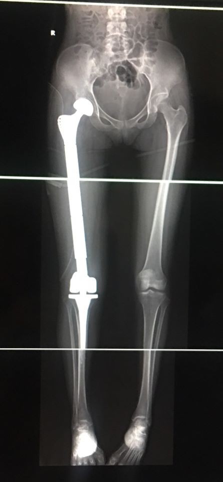 Phim chụp lại sau mổ của bệnh nhân H. Ảnh: Sơn Tùng