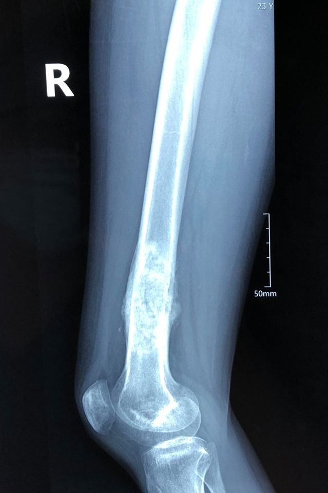 Ảnh X-quang đùi phải của bệnh nhân H. khi phát hiện ung thư xương ác tính. Ảnh: Sơn Tùng