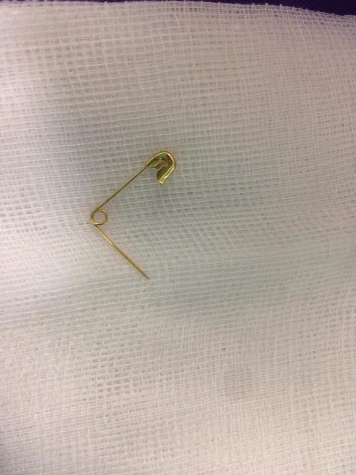 Chiếc kim băng trong thực quản bé gái. Ảnh: Minh Thúy Chiếc kim băng trong thực quản bé gái. Ảnh: Minh Thúy