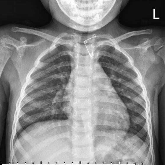 Phim chụp X-quang ccủa bé gái. Ảnh: BVCC Phim chụp X-quang ccủa bé gái. Ảnh: BVCC