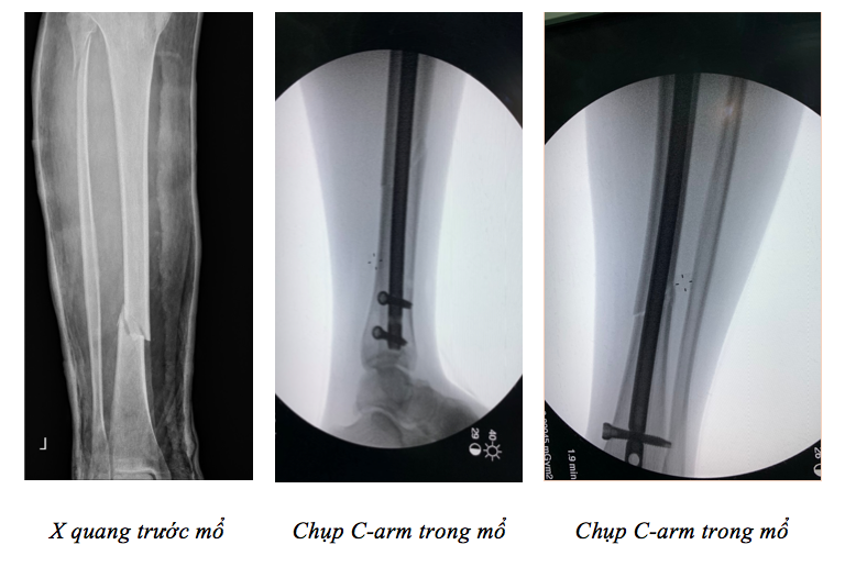 Phim chụp X-quang của bệnh nhân. Ảnh: BVCC