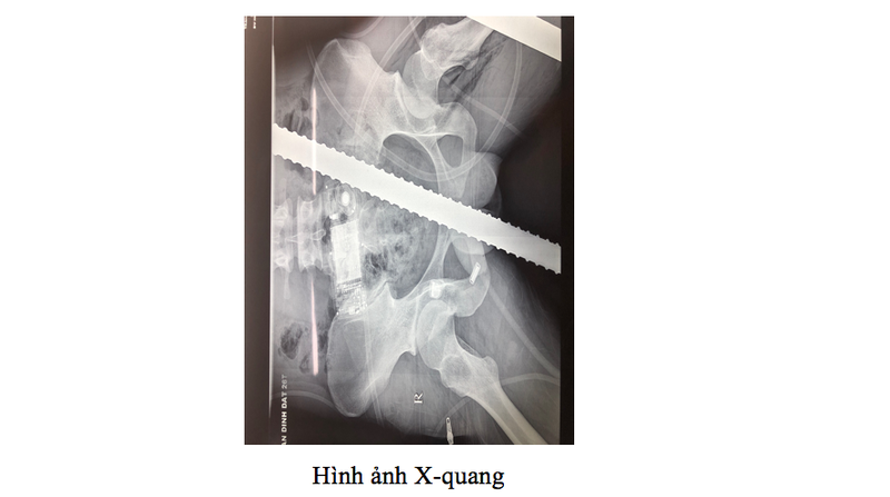 Ảnh chụp X-quang của bệnh nhân. Ảnh: BVCC Ảnh chụp X-quang của bệnh nhân. Ảnh: BVCC