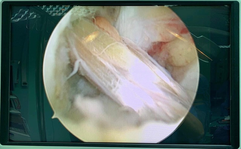 Dây chằng chéo trước ccủa bệnh nhân sau khi được tái tạo thành công. Ảnh: BVCC