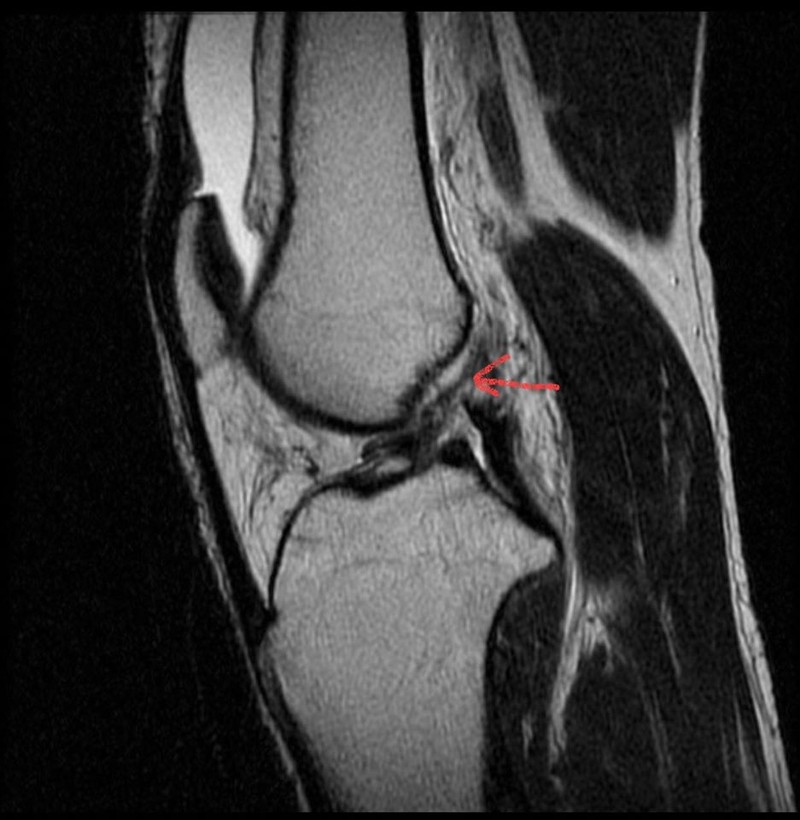 Hình ảnh đứt dây chằng chéo trước của bệnh nhân trên phim MRI. Ảnh: BVCC