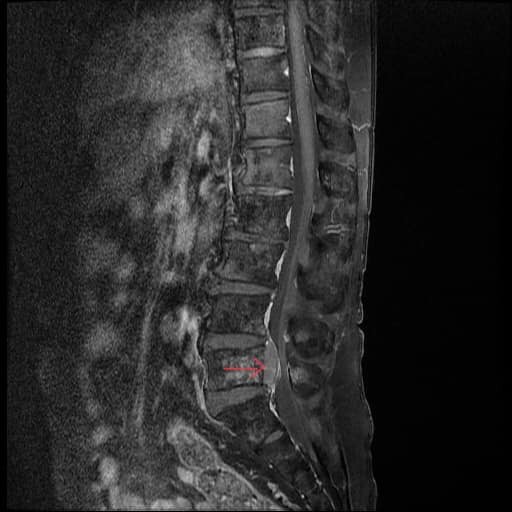 Hình ảnh khối u chèn ép tủy sống trên phim MRI của bệnh nhân. Ảnh: BVCC