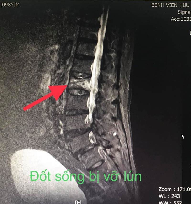 Đốt sống bị vỡ lún của bệnh nhân. Ảnh: BVCC Đốt sống bị vỡ lún của bệnh nhân. Ảnh: BVCC
