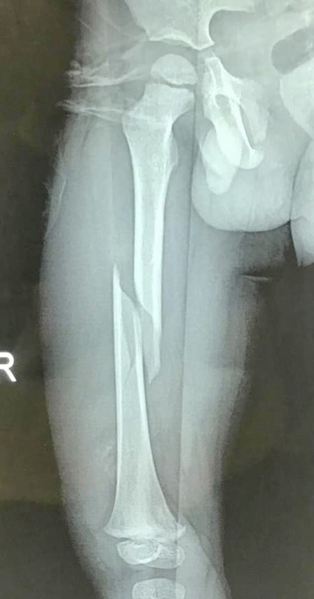 Phần xương đùi bị gãy của bệnh nhi. Ảnh: Bệnh viện Hữu Nghị