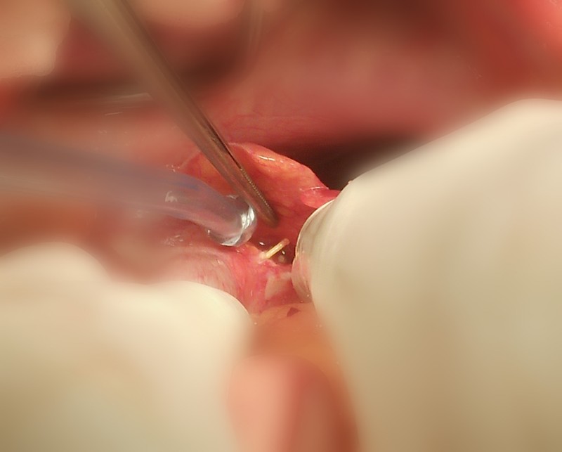 Hình ảnh chiếc tăm tre đâm thủng đại tràng của bệnh nhân. Ảnh: BS. Hoàng Việt Dũng