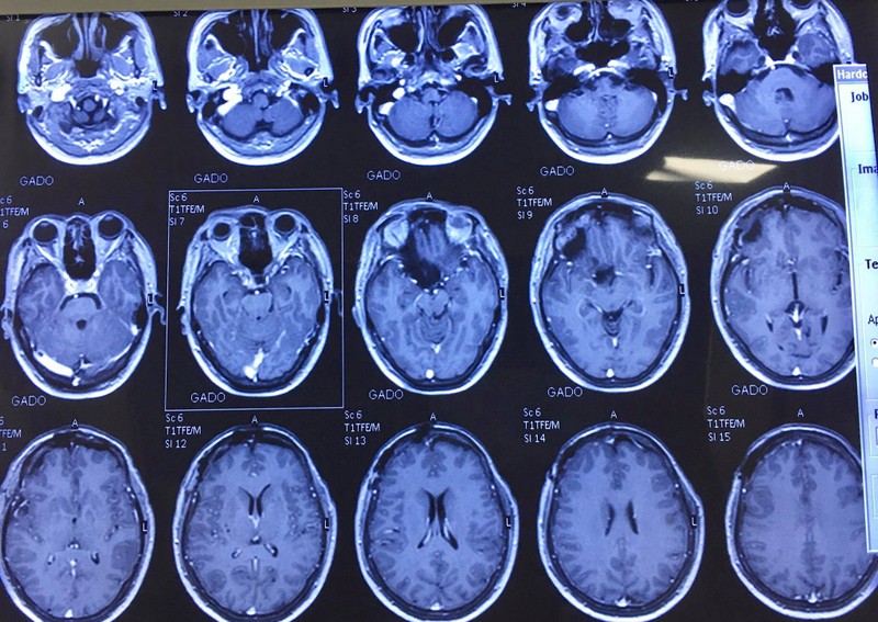 Phim chụp của bệnh nhân sau phẫu thuật. Ảnh: Bệnh viện Hữu nghị Việt Đức