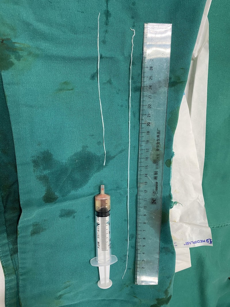 Giun Dracunculus medinensis được găp ra từ cơ thể bệnh nhân. Ảnh: Bệnh viện Bệnh Nhiệt đới Trung ương