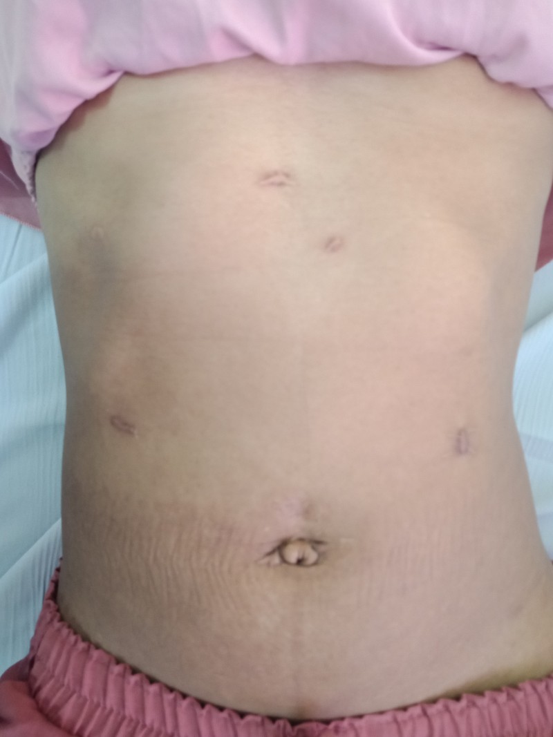 Sẹo mổ nội soi của bệnh nhân sỏi mật sau phẫu thuật 1 năm (Ảnh: Bệnh viện Hữu nghị Việt Đức) Sẹo mổ nội soi của bệnh nhân sỏi mật sau phẫu thuật 1 năm (Ảnh: Bệnh viện Hữu nghị Việt Đức)