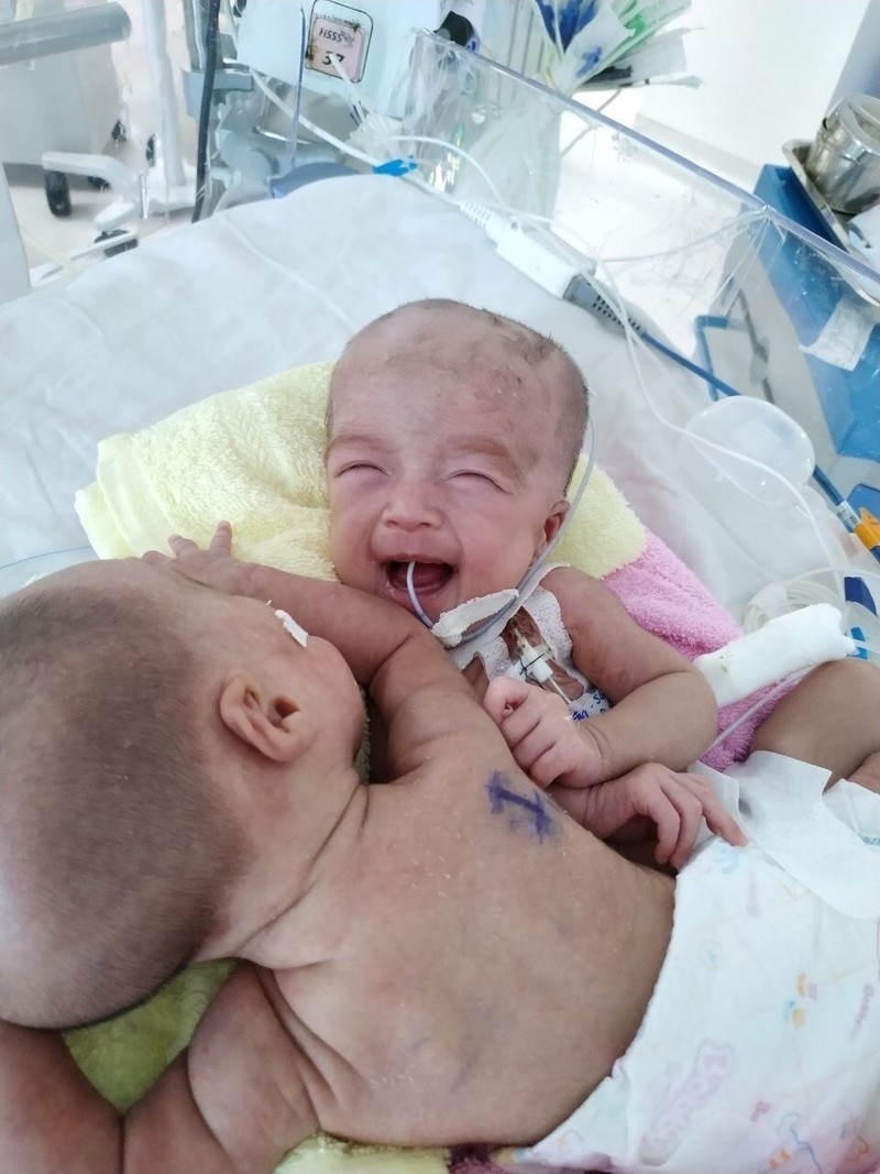 2 bé song sinh khi mới chào đời (Ảnh: Bệnh viện Nhi đồng Thành phố) 2 bé song sinh khi mới chào đời (Ảnh: Bệnh viện Nhi đồng Thành phố)