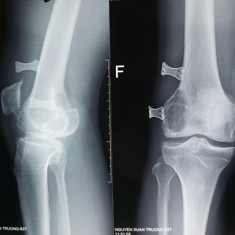 Phim chụp X-quang khớp gối của bệnh nhân (Ảnh: BVCC)