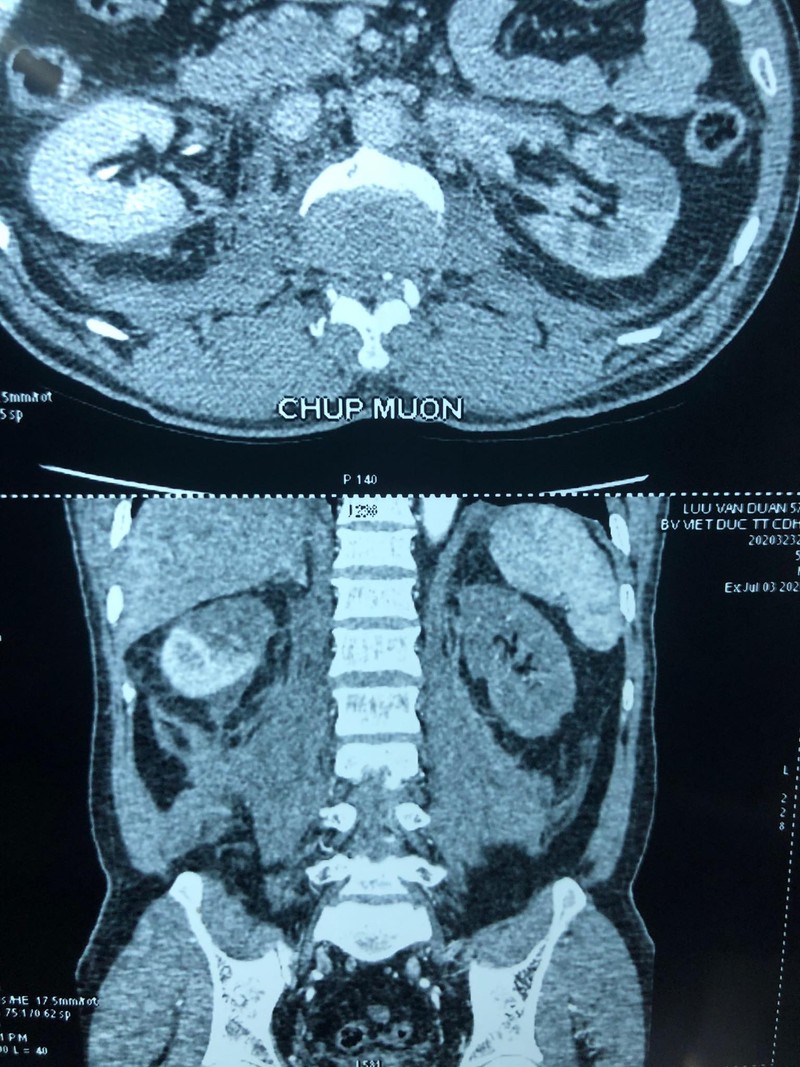 Phim chụp trước mổ của bệnh nhân D. (Ảnh: Bệnh viện Hữu nghị Việt Đức) 