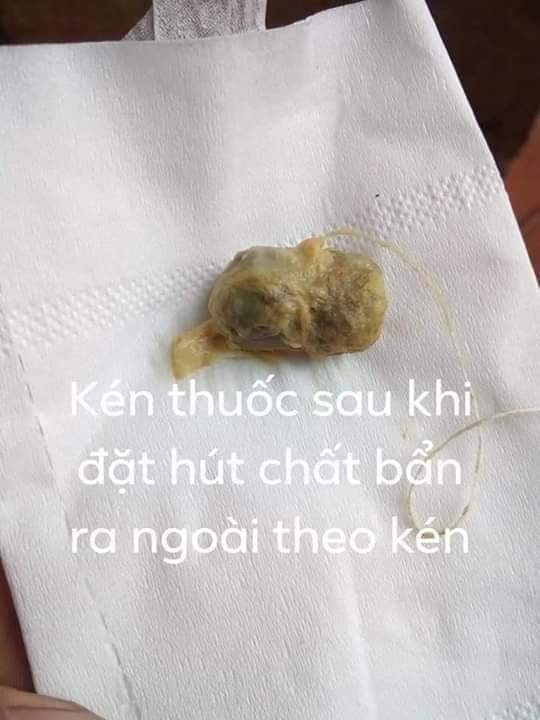 Kén thuốc sau khí sử dụng (Ảnh: FB H.T)