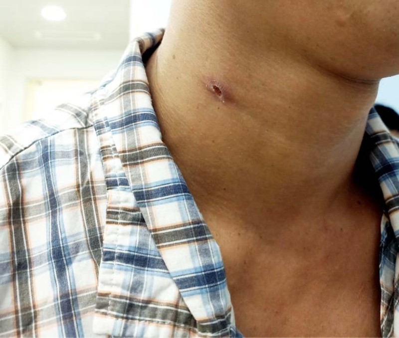 Vết thương do đạn bắn trên cổ bệnh nhân (Ảnh: BVCC) Vết thương do đạn bắn trên cổ bệnh nhân (Ảnh: BVCC)