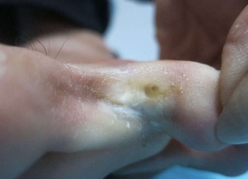 Một bệnh nhân bị nấm kẽ chân (Ảnh: BS. Lê Thị Mai)