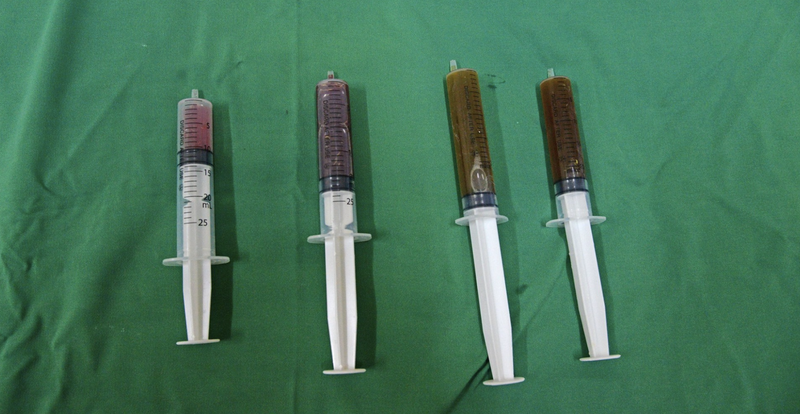 Dịch máu được hút ra từ nang giáp của bệnh nhân (Ảnh: BVCC)