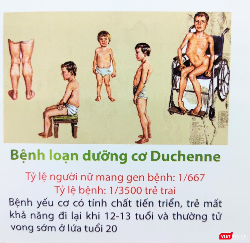 Bệnh loạn dưỡng cơ Duchenne (Ảnh: Minh Thuý) Bệnh loạn dưỡng cơ Duchenne (Ảnh: Minh Thuý)