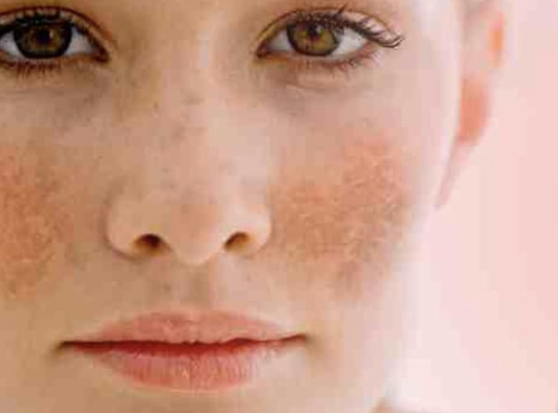 Nám da (Ảnh: Boldsky) Nám da (Ảnh: Boldsky)