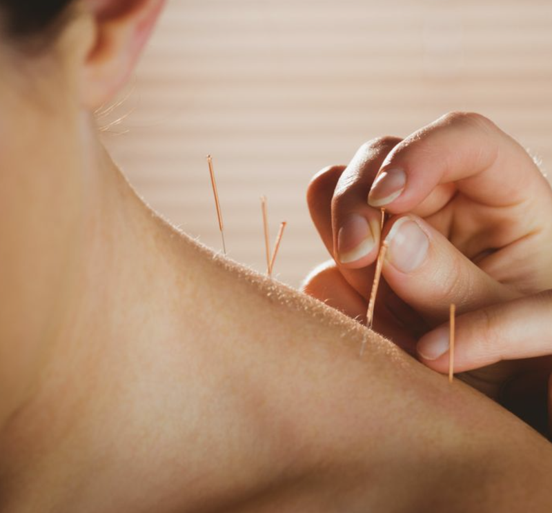 Châm cứu (Ảnh: Brightside) Châm cứu (Ảnh: Brightside)