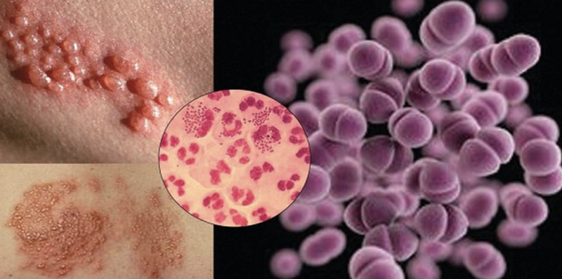 Bệnh lậu (ảnh minh hoạ) Bệnh lậu (ảnh minh hoạ)