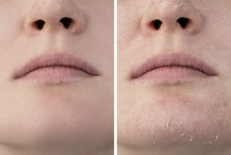 Da bị ảnh hưởng vì mặc quá ấm trong thời gian dài (Ảnh: Brightside)