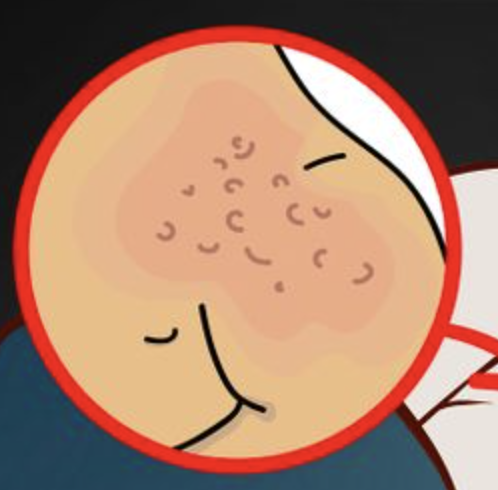 Mồ hôi ra nhiều khiến bạn dễ nổi mụn (Ảnh: Brightside)