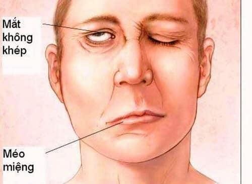 Biểu hiện rõ nét nhất của bệnh liệt mặt, méo miệng là khuôn mặt mất cân xứng (Ảnh: BVCC) Biểu hiện rõ nét nhất của bệnh liệt mặt, méo miệng là khuôn mặt mất cân xứng (Ảnh: BVCC)
