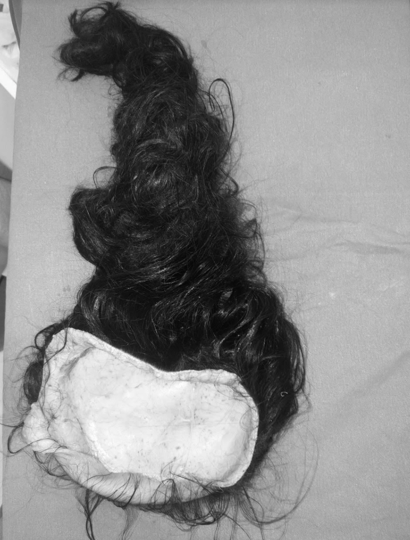 Phần da đầu bị lột của bé Đ. (Ảnh: BVCC)