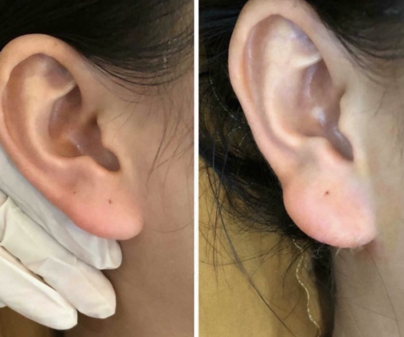 Hàng loạt spa đang quảng cáo tiêm filler dáng "tai phật" khiến nhiều người tin tưởng và quyết định đi nâng cấp đôi tai (Ảnh minh hoạ) Hàng loạt spa đang quảng cáo tiêm filler dáng "tai phật" khiến nhiều người tin tưởng và quyết định đi nâng cấp đôi tai (Ảnh minh hoạ)