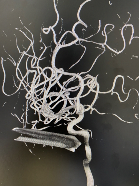 Hình ảnh thanh sắt đâm vào mặt bệnh nhân (Ảnh - BVCC) Hình ảnh thanh sắt đâm vào mặt bệnh nhân (Ảnh - BVCC)