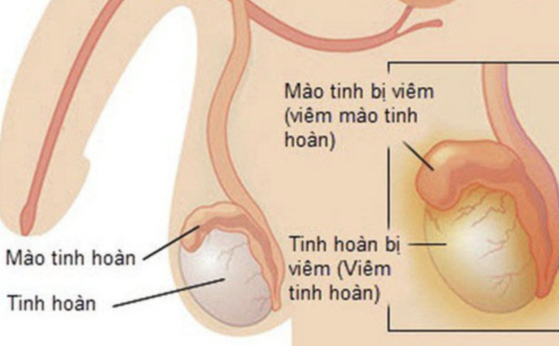 Hình ảnh viêm mào tinh hoàn và viêm tinh hoàn (Ảnh - Khoa Nam học và Y học giới tính, Bệnh viện Đại học Y Hà Nội)
