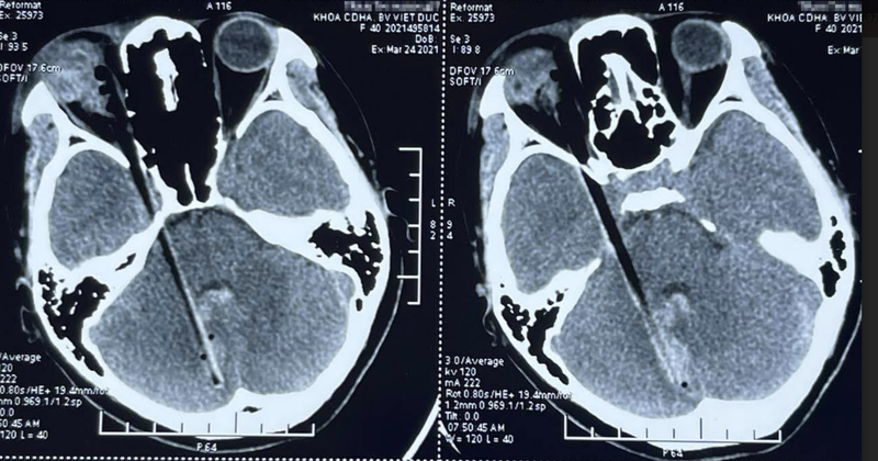 Hình ảnh dị vật đâm xuyên qua hốc mắt, vào sọ não của bệnh nhân (Ảnh - BVCC)